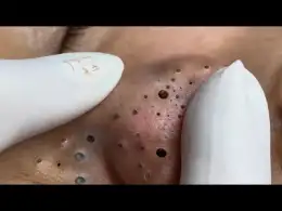 Treatment of Blackheads and Hidden Acne at Loan Nguyen Spa | 031